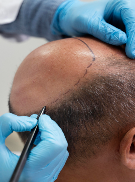 TRANSPLANTE-CAPILAR-novosite